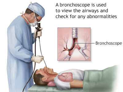 Bronchoscopy diagnostic and therapeutic procedure by pulmonologist
